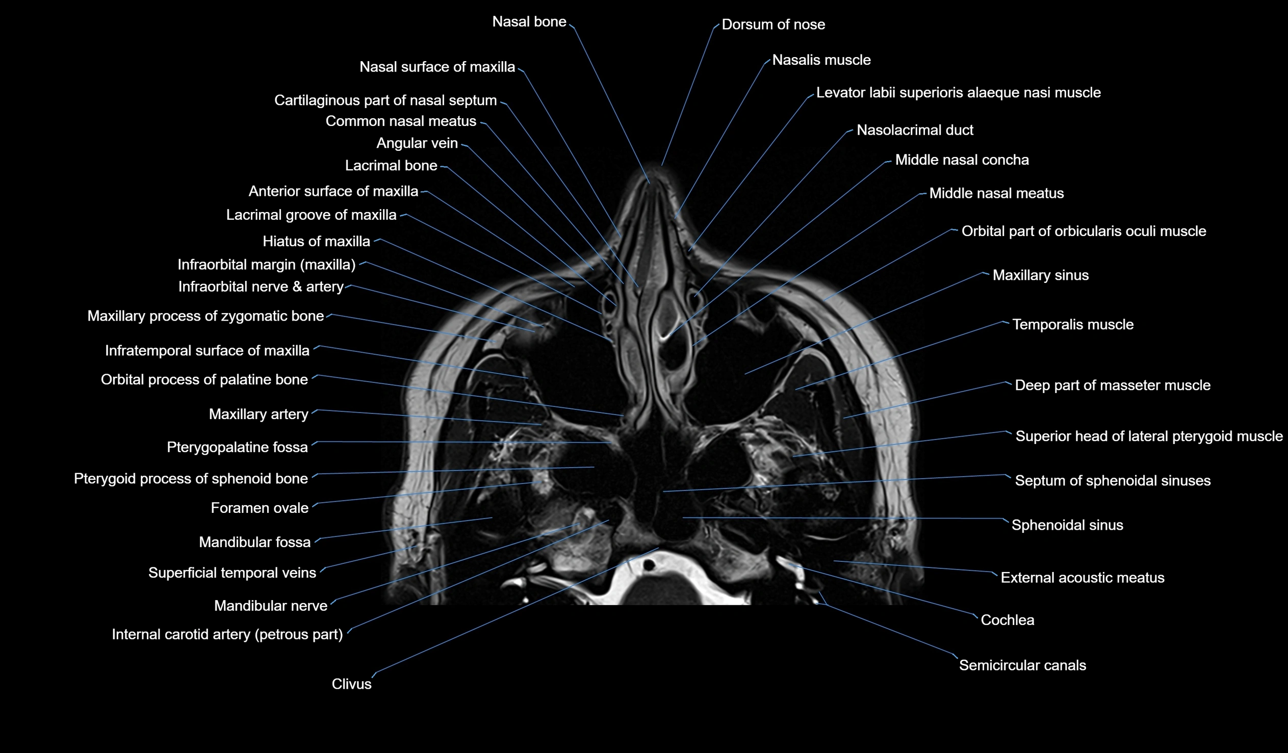 MRI face & paranasal sinuses(PNS) labelled  axial  cross sectional anatomy 3T radiology  image -00014.webp
